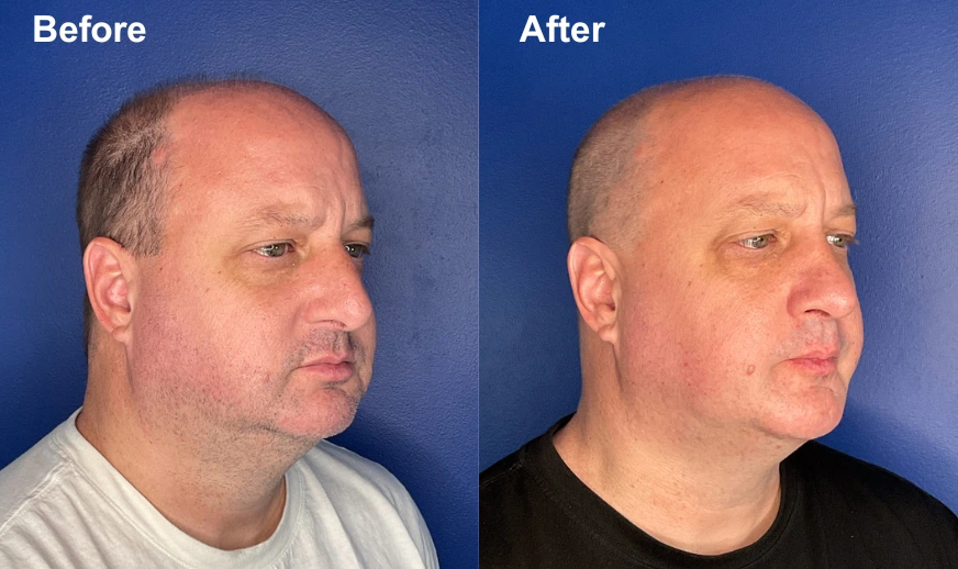 Before and after side profile showing facial projection and definition