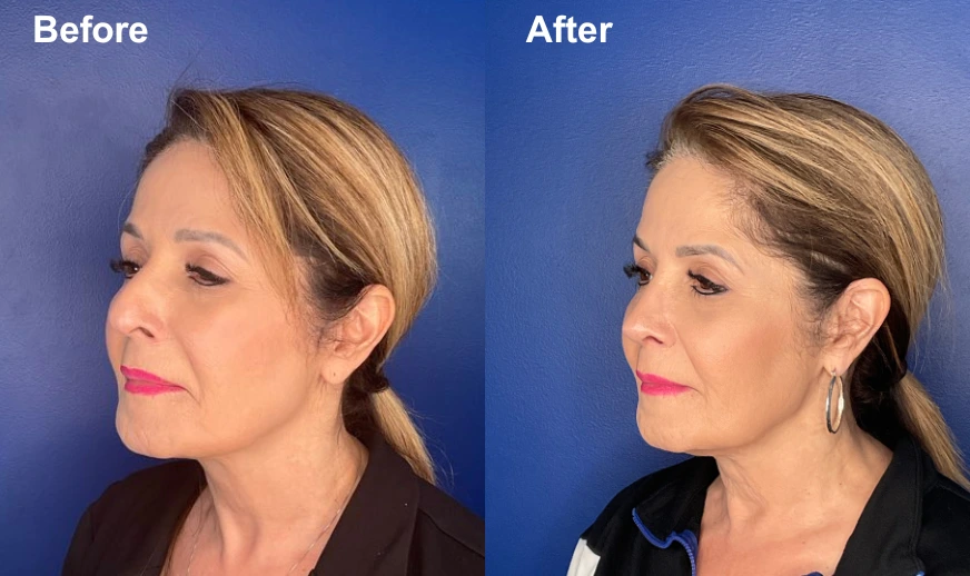 Before and after profile view showing refined facial contours