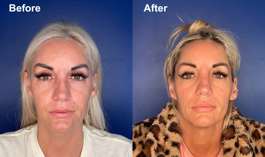 Before and after front-facing view showing facial refinement