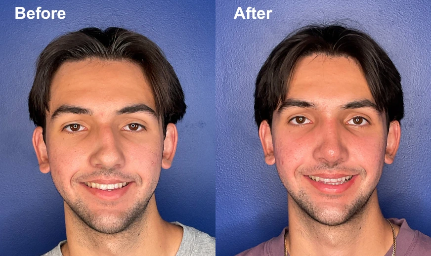 Before and after front-facing view showing facial structure enhancement