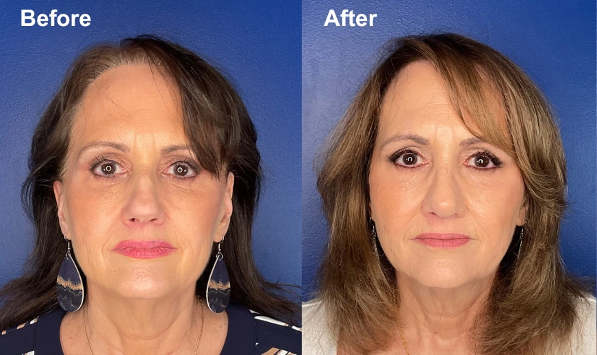 Woman's face before and after facial plastic surgery, frontal view showing improved skin texture and facial contours