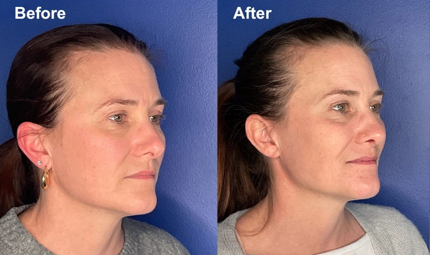 Woman's profile before and after facial plastic surgery showing refined chin and jawline definition