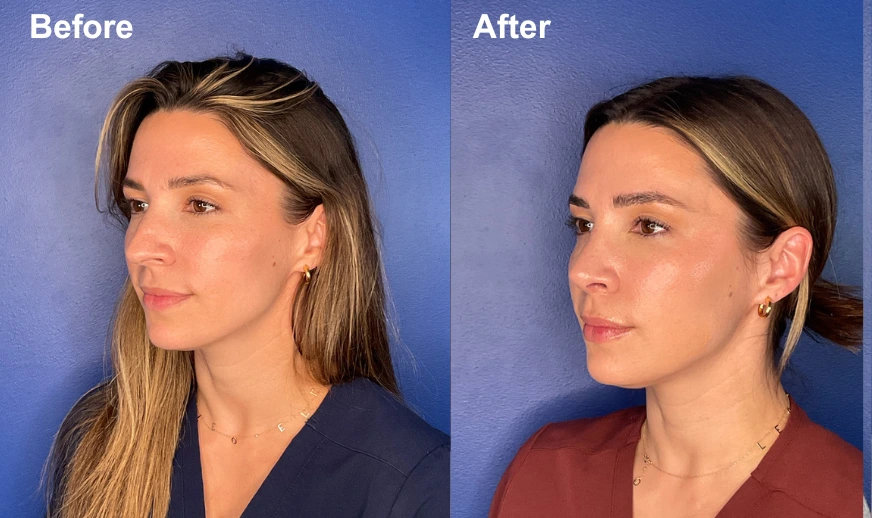 Woman's profile before and after facial plastic surgery demonstrating enhanced facial structure and chin projection