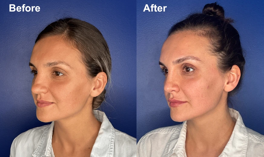 Woman's profile before and after facial plastic surgery showing improved chin definition and overall facial balance