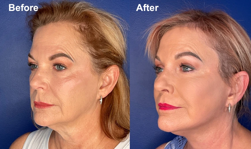 Woman's profile before and after brow lift surgery showing elevated brow position and refined facial proportions