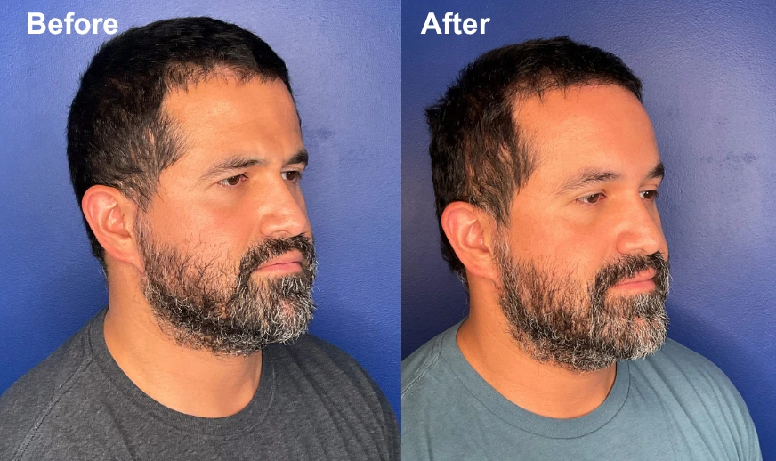 Before and after profile view showing brow lift results with improved brow position and reduced forehead wrinkles