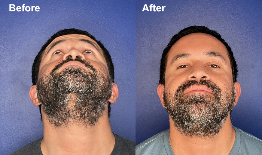 Before and after upward-facing view showing brow lift results with improved brow elevation and facial balance