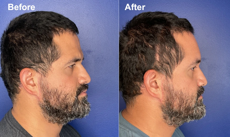 Before and after profile view showing brow lift with elevated brow height and improved forehead appearance