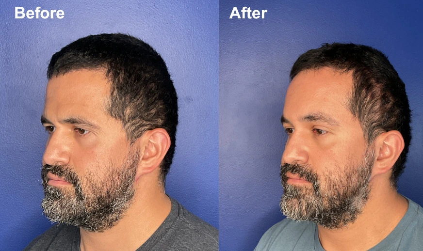 Before and after profile view showing brow lift with elevated brow arch and smoother forehead