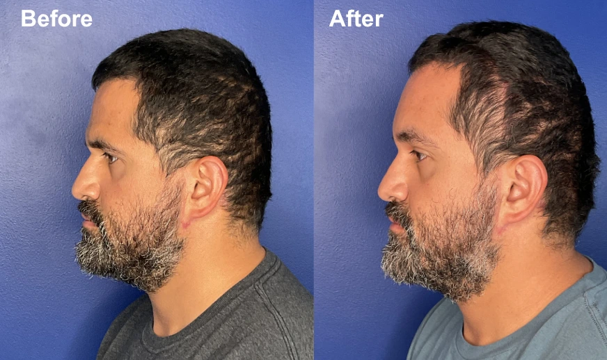 Before and after profile view showing brow lift with lifted brow position and refined forehead contour