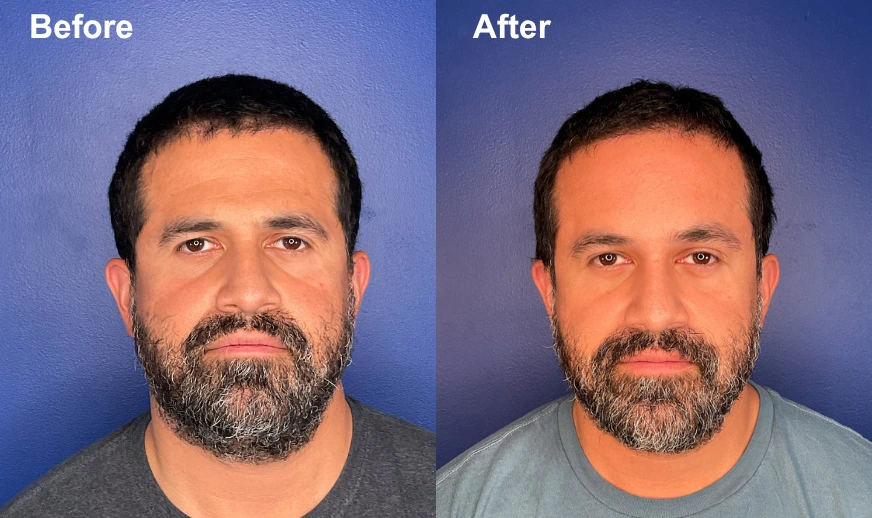 Before and after frontal views of male patient showing brow lift results