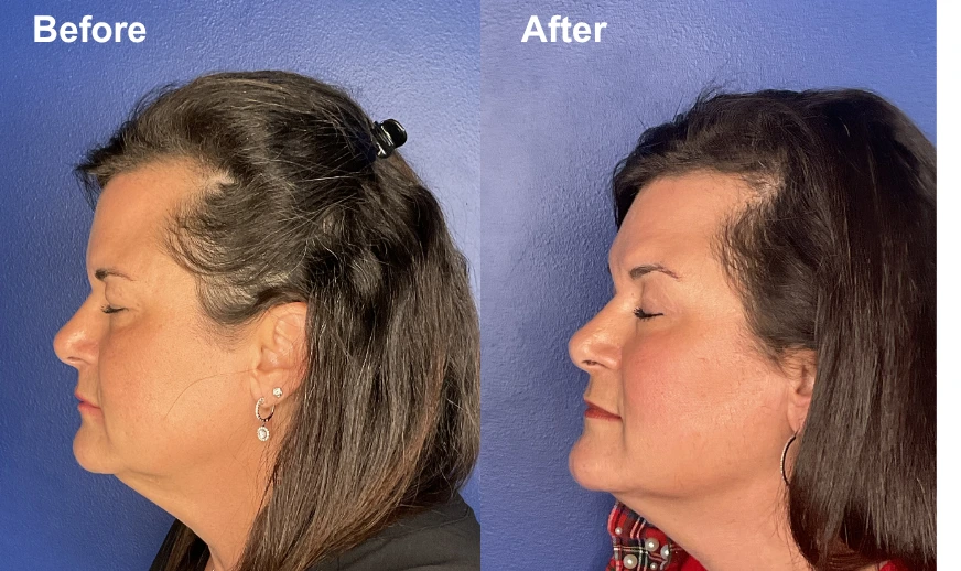 Before and after side profile showing facial contour refinement