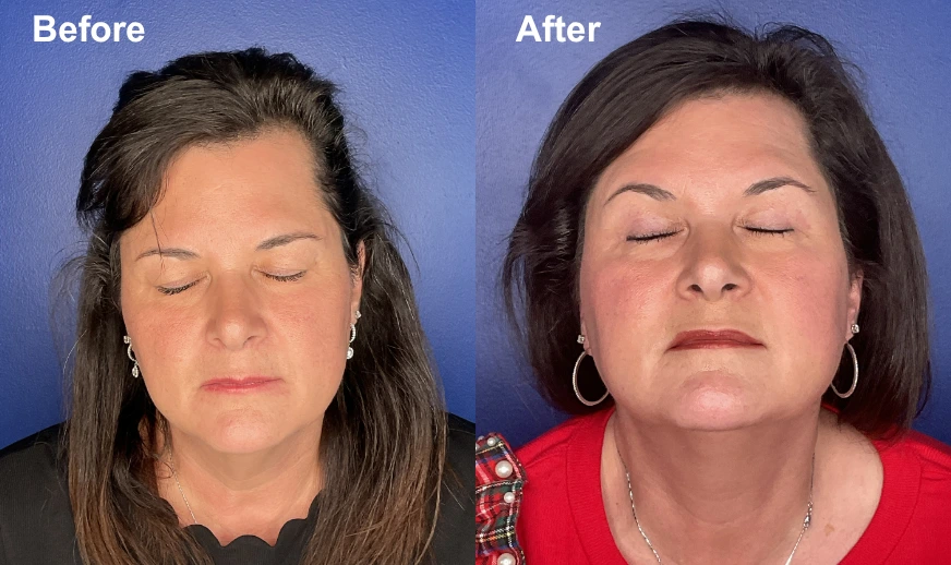 Before and after front-facing view showing facial structure improvement