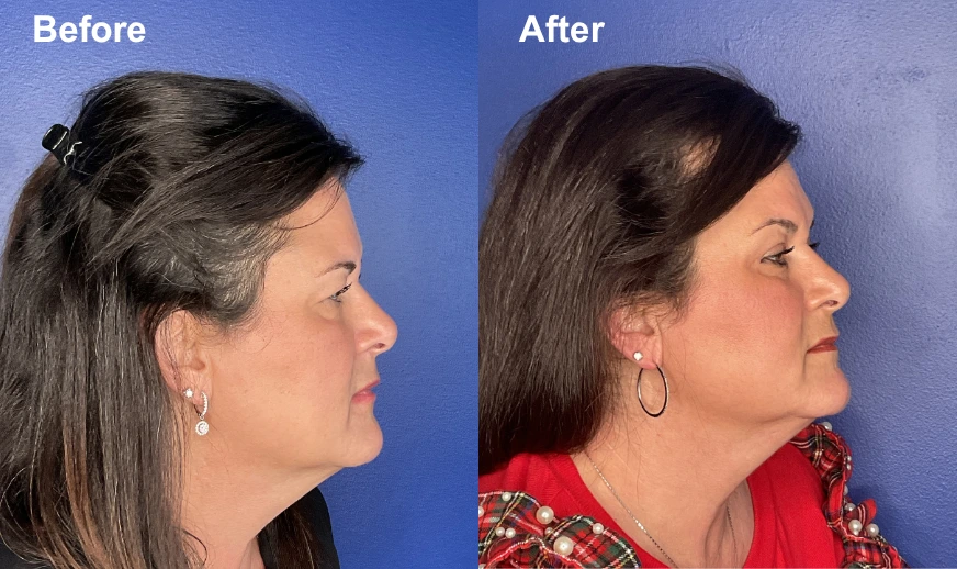 Before and after profile view showing chin and jawline enhancement