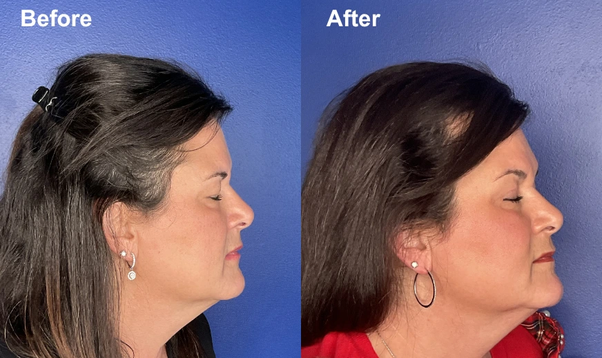 Before and after profile comparison with improved chin definition