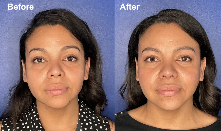Before and after frontal view showing enhanced facial definition and refined jawline on female patient