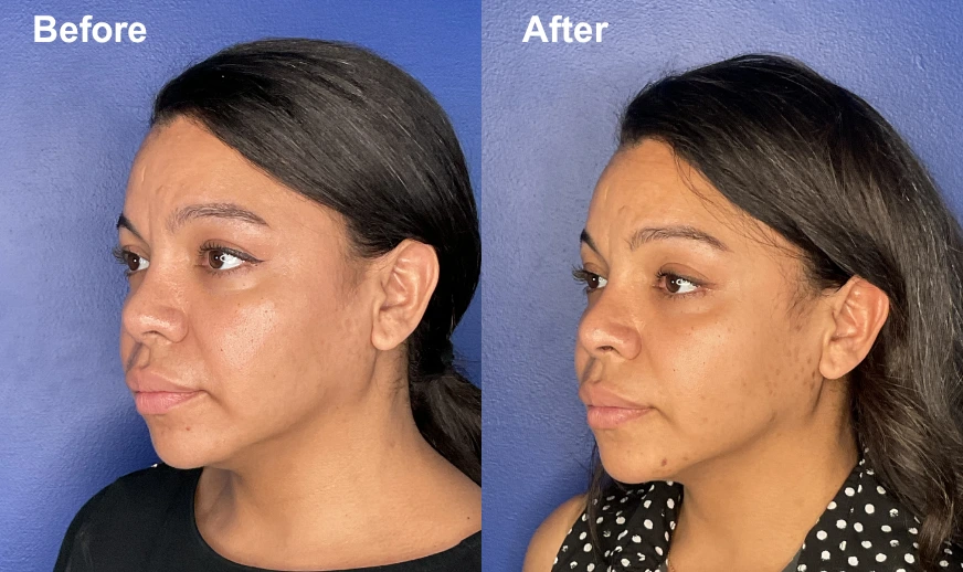 Before and after side profile showing improved chin definition and jawline contour on female patient