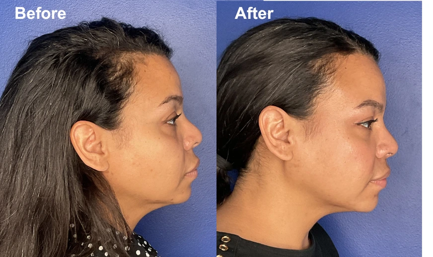 Before and after side profile showing defined jawline and improved chin projection on female patient