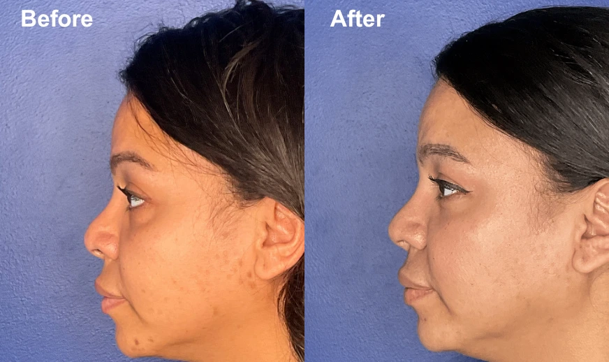 Before and after profile views showing facial contouring results