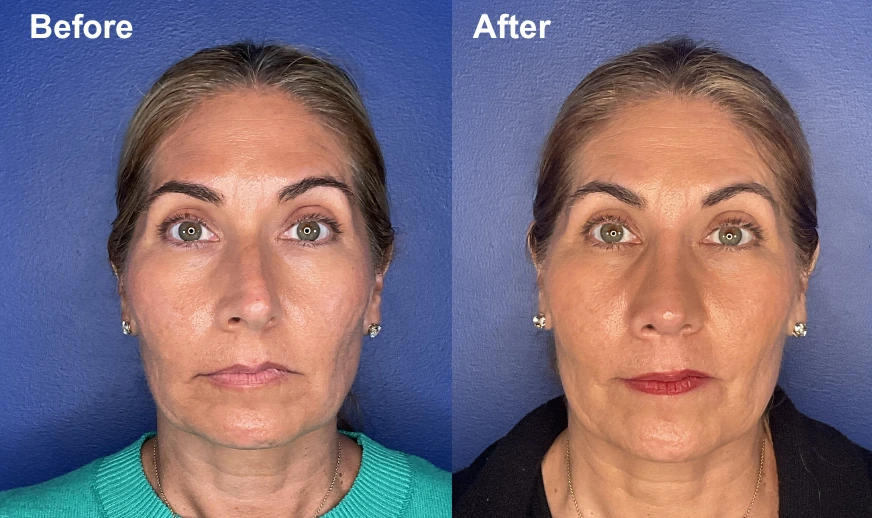 Before and after frontal view showing lifted facial contours and improved skin quality on female patient