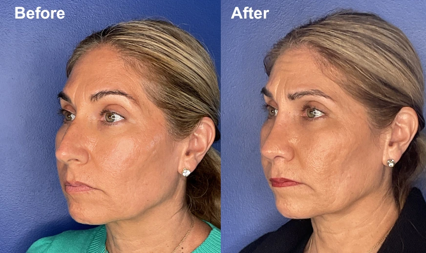 Before and after side profile showing refined jawline and reduced jowling on female patient