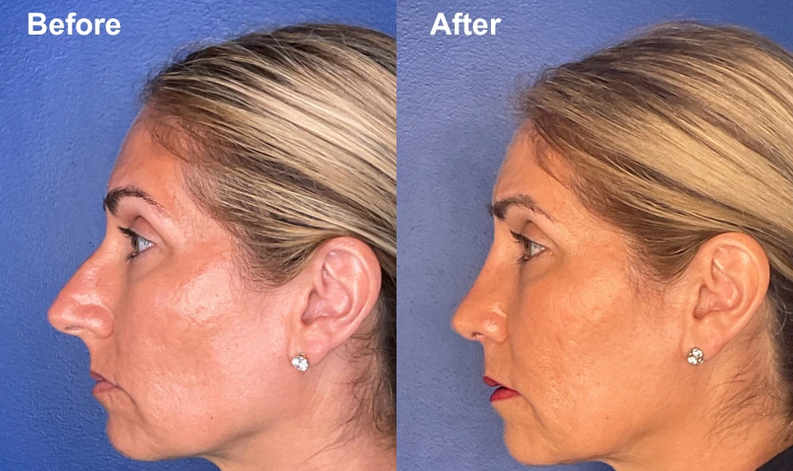 Woman's profile before and after facial plastic surgery showing refined nasal contours