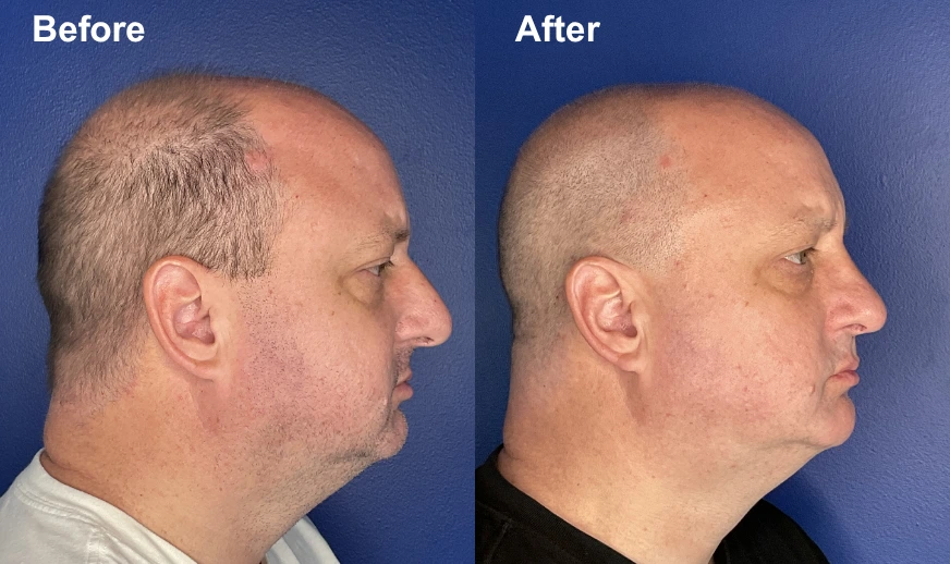 Before and after side profile views of a man's face showing enhanced facial definition