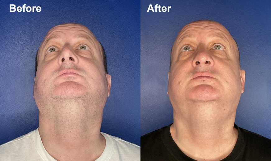 Before and after facial treatment showing improved skin texture and reduced sagging on male patient's face