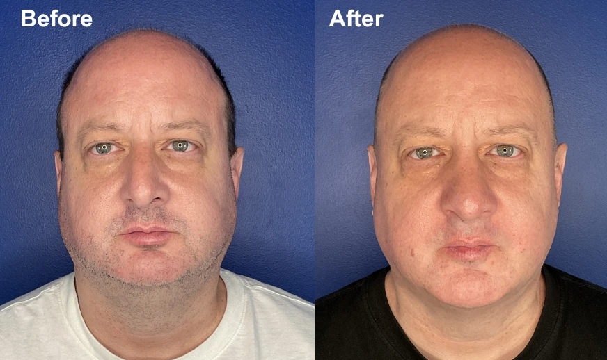 Before and after frontal views of a man's face showing facial rejuvenation
