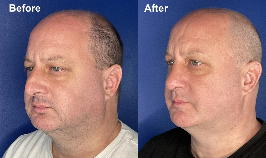 Before and after side profile views of a man's face showing facial improvement