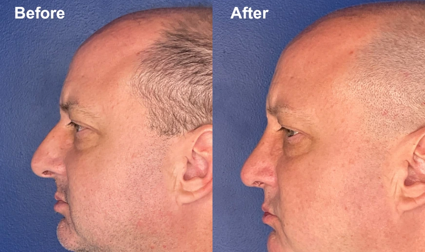 Man's profile before and after facial plastic surgery showing improved facial definition