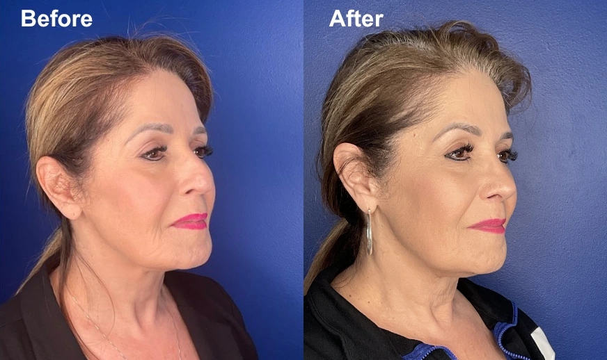 Before and after side profile views of a woman's face showing improved facial contour