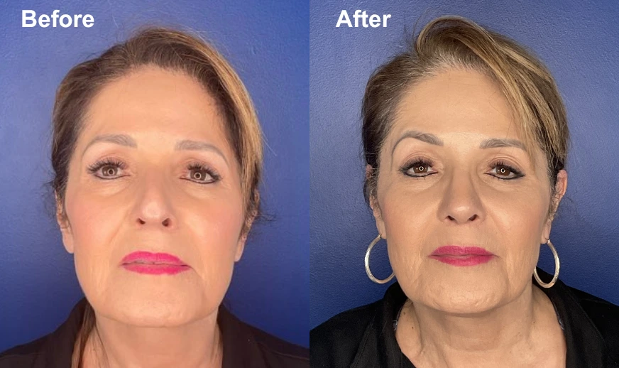 Before and after frontal views of a woman's face showing facial enhancement results