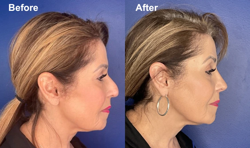 Before and after female patient profile showing chin and jawline refinement