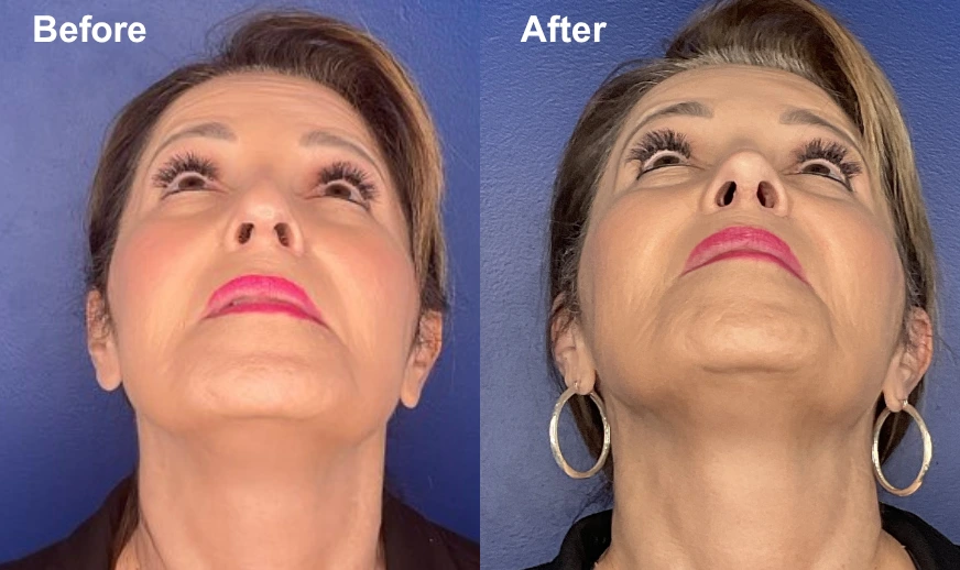 Before and after upward-facing views of a woman's face showing facial rejuvenation results