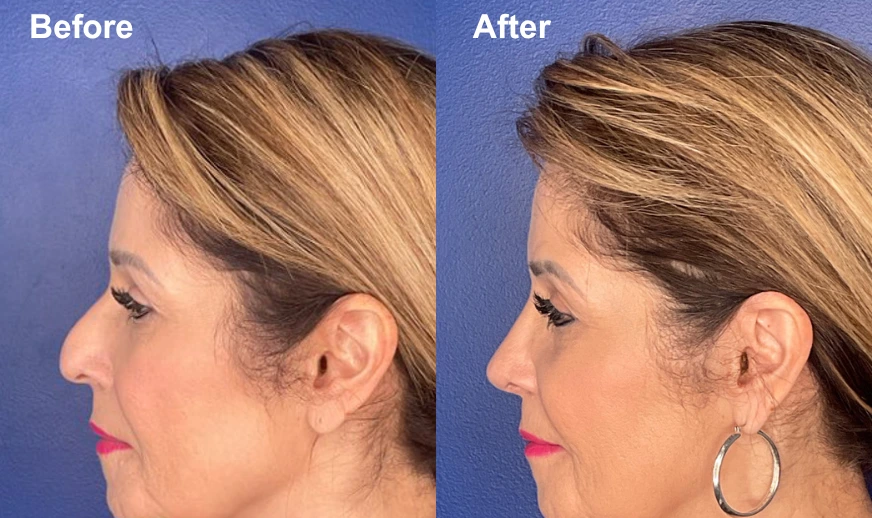 Woman's profile before and after facial plastic surgery showing enhanced facial harmony