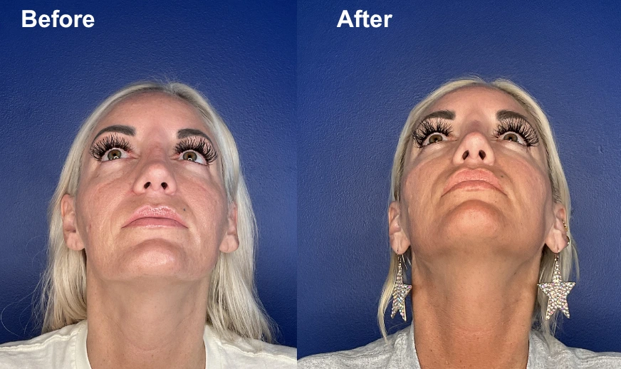 Before and after female patient looking upward showing chin and lower face changes