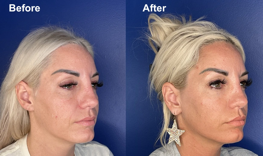 Before and after female patient profile showing chin projection and jawline enhancement