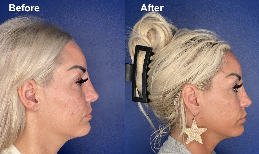 Before and after female patient profile showing jaw and chin contour changes