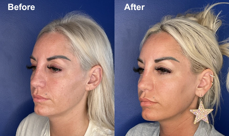 Before and after female patient profile showing jawline definition improvement