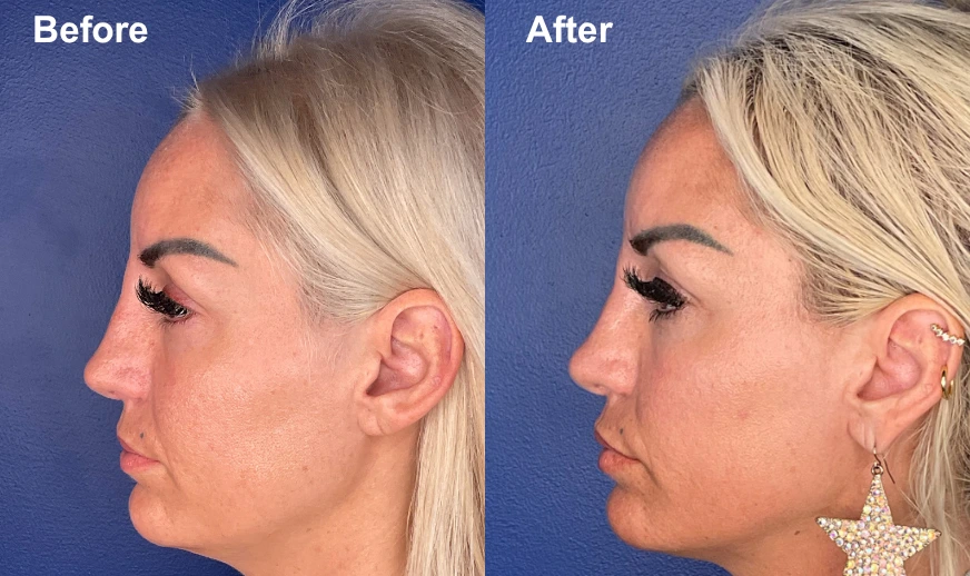 Woman's profile before and after facial plastic surgery showing refined chin projection