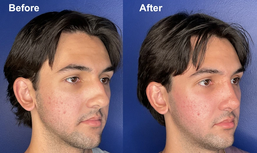 Man's profile comparison showing improved cheek and jawline definition after treatment