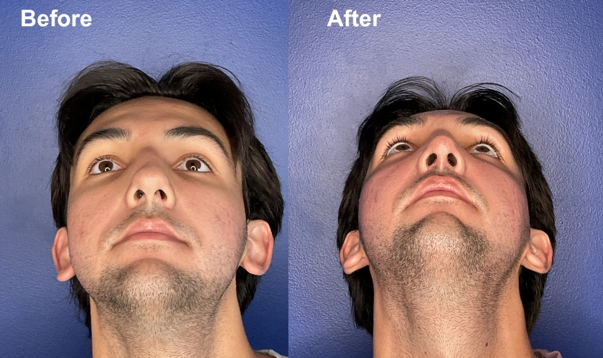 Before and after male patient comparison showing facial profile changes from below, eyes upward