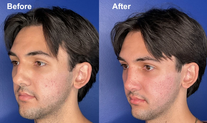 Man's profile comparison showing improved facial contours and skin tone after treatment