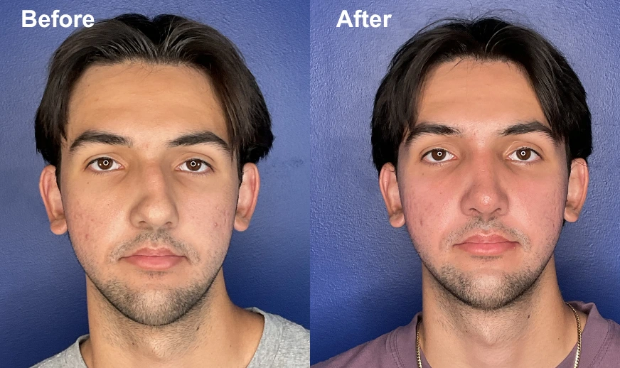Man's frontal view before and after showing enhanced facial balance and skin appearance