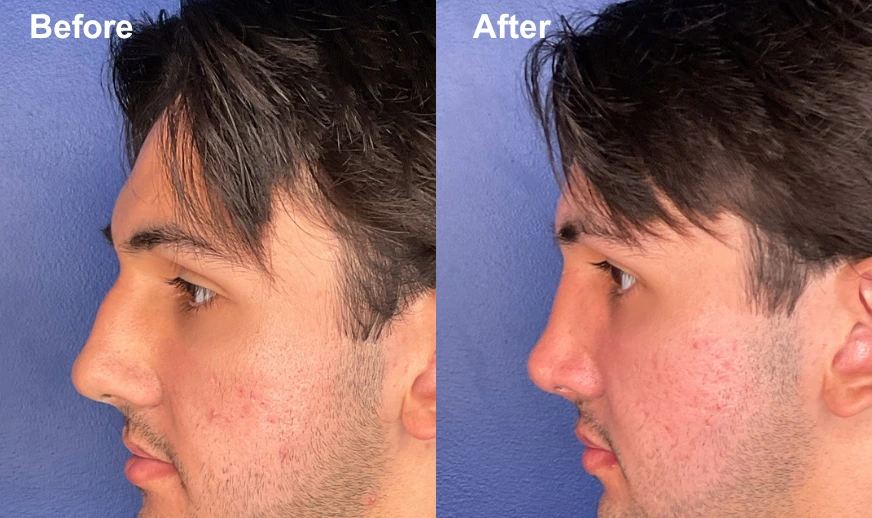 Man's profile before and after facial plastic surgery showing improved nasal structure