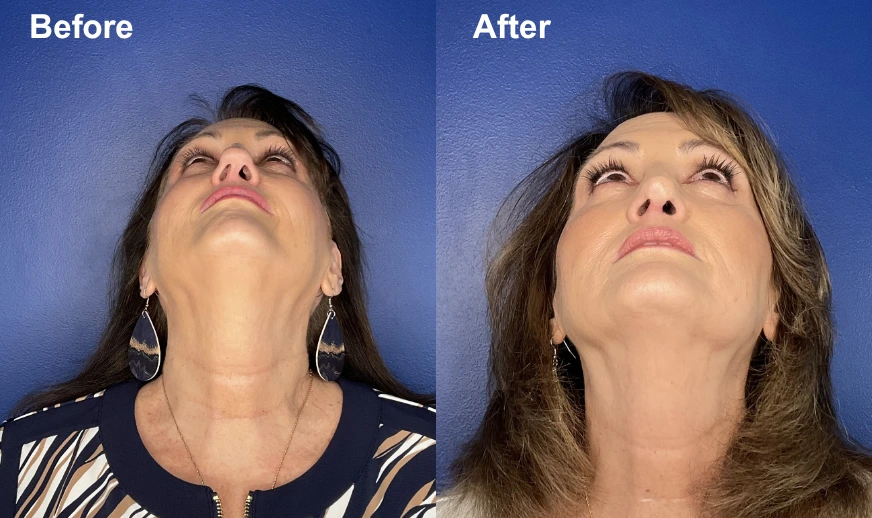 Woman's upward-facing view before and after showing improved facial definition and skin texture