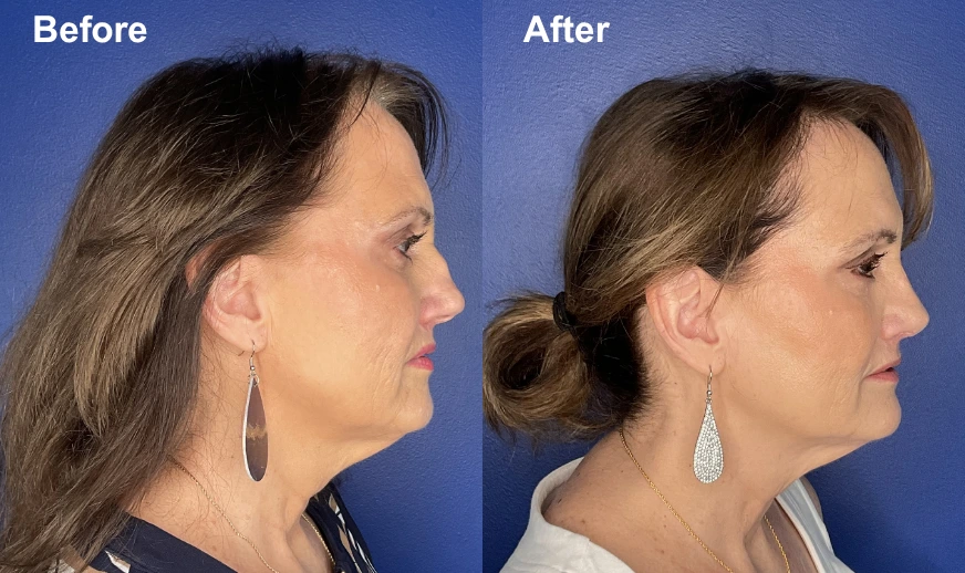 Woman's profile comparison showing enhanced jawline and neck definition after treatment