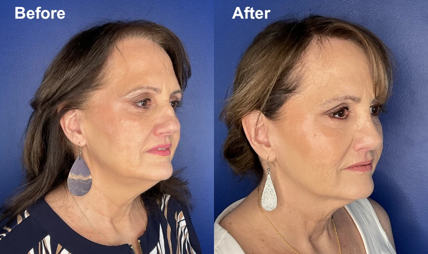 Before and after profile photos showing improved jawline, chin, and neck contours