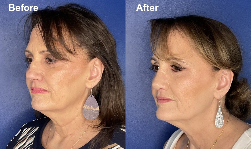 Woman's profile comparison showing facial contours before and after cosmetic treatment